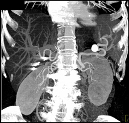 Splenic Artery Aneurysm - CTisus CT Scan