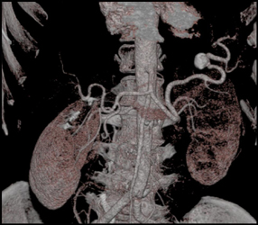 Splenic Artery Aneurysm - CTisus CT Scan