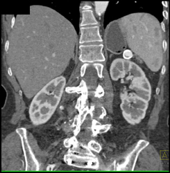 Splenic Artery Aneurysm - CTisus CT Scan