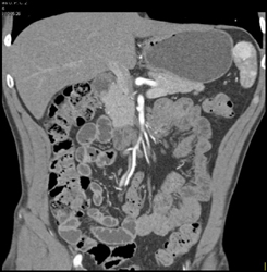 Splenic Hemangiomas - CTisus CT Scan