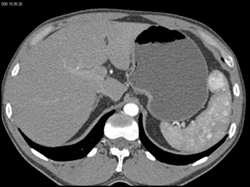 Splenic Hemangiomas - CTisus CT Scan