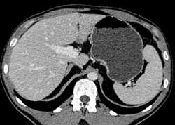 Splenic Hemangiomas - CTisus CT Scan