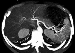 Splenic Hemangiomas - CTisus CT Scan