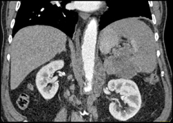 Pancreatic Cancer Occludes Splenic Arteries and Vein With Splenic Infarction - CTisus CT Scan