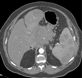 Lymphoma Involves the Spleen - CTisus CT Scan