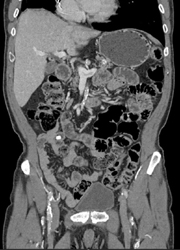 Splenic Vein Thrombosis - CTisus CT Scan