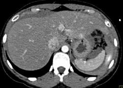 Perisplenic Bleed - CTisus CT Scan