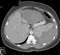 Splenic Laceration and Bleed With Hemoperitoneum - CTisus CT Scan