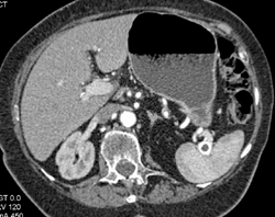 Splenic Artery Aneurysm - CTisus CT Scan