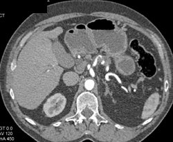 Encased Splenic Artery By Pancreatic Mass - CTisus CT Scan