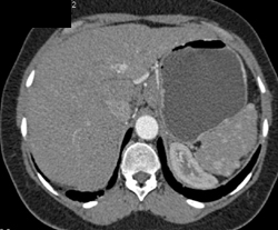 Splenic Hemangiomas - CTisus CT Scan