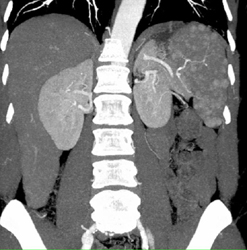 Splenic Hemangiomas - CTisus CT Scan