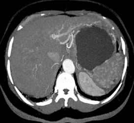 Splenic Hemangiomas - CTisus CT Scan