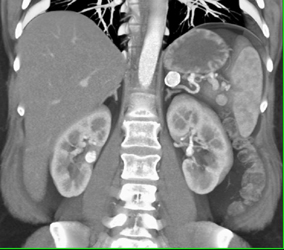 Splenic Artery Aneurysms - CTisus CT Scan