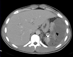 Splenic Abscess - CTisus CT Scan