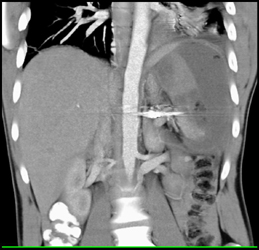 Splenic Abscess - CTisus CT Scan