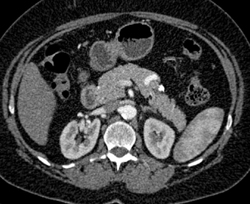 Splenic Artery Aneurysm - CTisus CT Scan