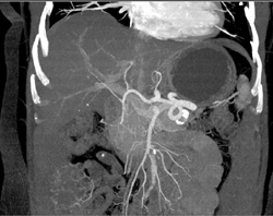 Splenic Artery Aneurysm - CTisus CT Scan