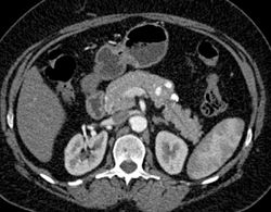 Splenic Artery Aneurysm - CTisus CT Scan