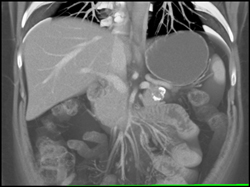 Splenic Infarct and Splenic Artery Aneurysm - CTisus CT Scan