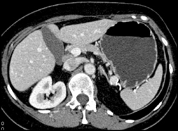 Splenic Artery Aneurysm - CTisus CT Scan