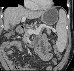 Splenic Vein Thrombosis-partial - CTisus CT Scan