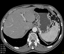 Islet Cell Tumor With Occlusion of Splenic Vein With Collaterals - CTisus CT Scan