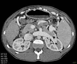 Splenorenal Shunting - CTisus CT Scan