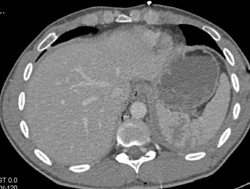 Splenic and Renal Laceration - CTisus CT Scan