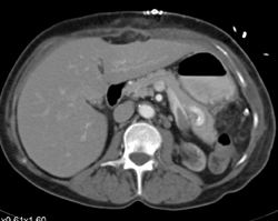 Partial Splenic Vein Thrombosis - CTisus CT Scan