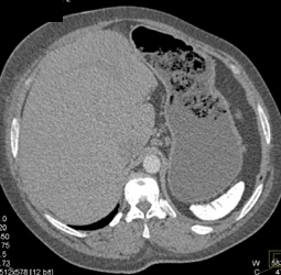 Sickle Cell Disease - CTisus CT Scan