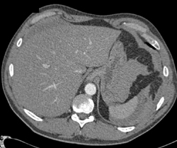 Splenic Hemorrhage Due to Laceration - CTisus CT Scan