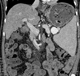 Splenic Artery Aneurysm - CTisus CT Scan