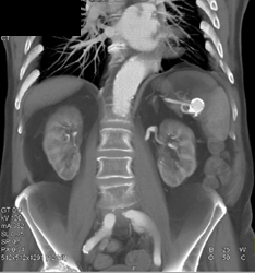 Splenic Artery Aneurysm - CTisus CT Scan