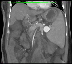 Splenic Artery Aneurysm With Portal Hypertension - CTisus CT Scan