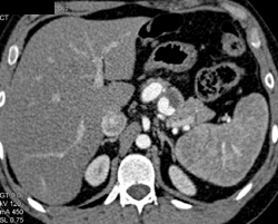 Splenic Artery Aneurysm - CTisus CT Scan