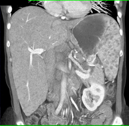 Sarcoidosis - CTisus CT Scan