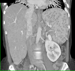 Sarcoidosis - CTisus CT Scan