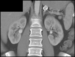 Splenic Artery Aneurysm and Renal Artery Aneurysms - CTisus CT Scan