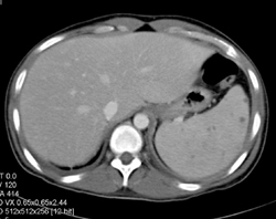 Splenic Abscess - CTisus CT Scan