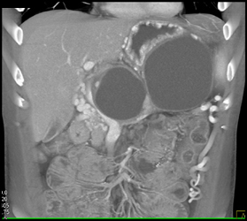 Pseudocyst Compress and Occlude the Splenic Vein With Collaterals - CTisus CT Scan