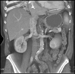 Splenic Artery Aneurysm - CTisus CT Scan