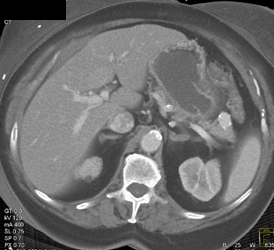 Splenic Artery Aneurysm - CTisus CT Scan