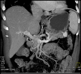 Splenic Artery Aneurysm - CTisus CT Scan