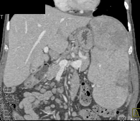 Splenic Infarcts - CTisus CT Scan