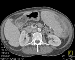 Splenic Infarcts - CTisus CT Scan