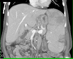 Splenic Infarcts - CTisus CT Scan