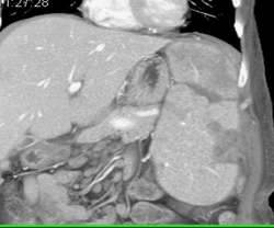 Splenic Infarcts - CTisus CT Scan