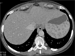 Sarcoidosis - Spleen Case Studies - CTisus CT Scanning