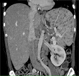 Sarcoidosis - CTisus CT Scan